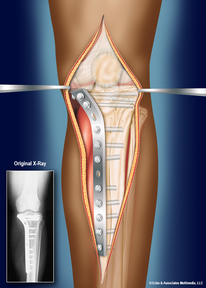 Bone Surgery Diagram